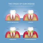Disease gum stop progression dentist