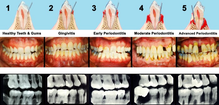 Gum periodontal cornell