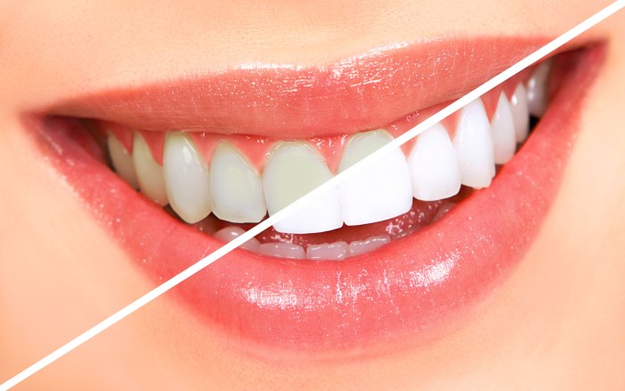 Whitening dental