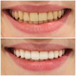 Teeth whitening dental before after smile cosmetic smiling consultation